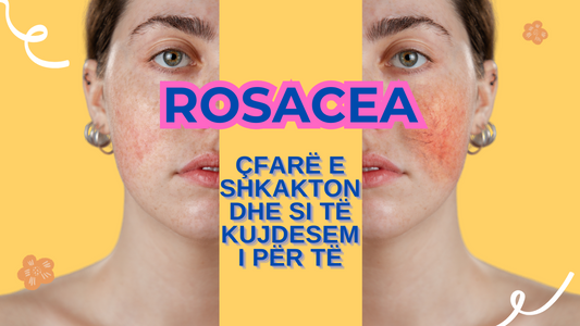 Rosacea: Çfarë e Shkakton dhe Si të Kujdesemi Për Të