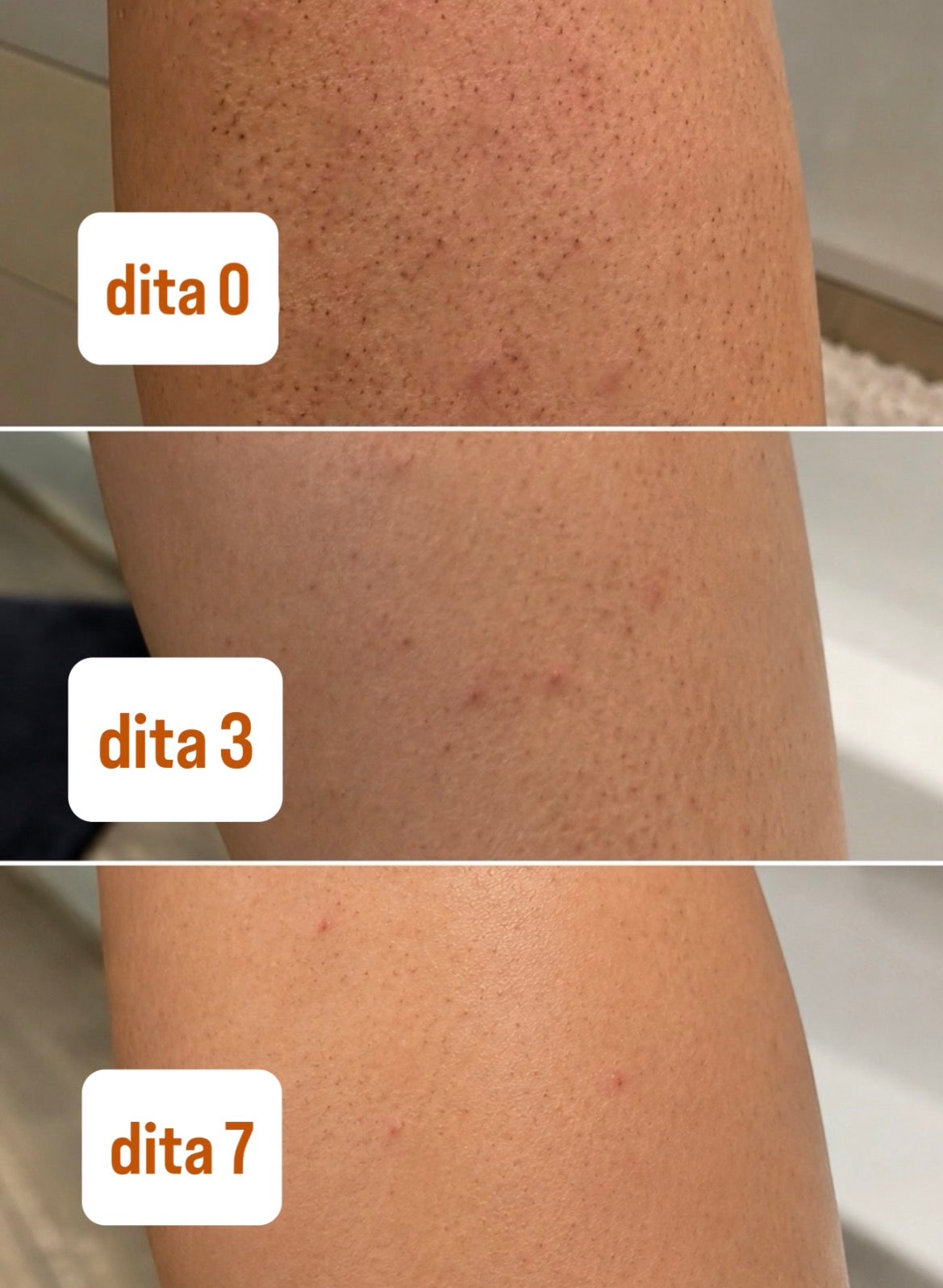 Hoily Drops Mini - Vaj trajtues për qime nën lëkurë dhe dorashkë eksfoliuese
