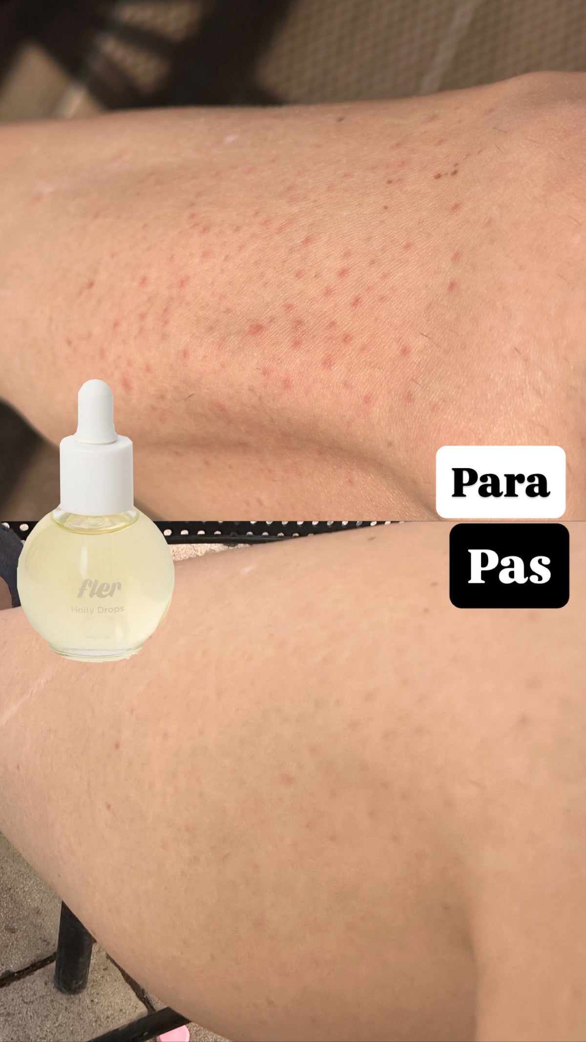Hoily Drops Mini - Vaj trajtues për qime nën lëkurë dhe dorashkë eksfoliuese